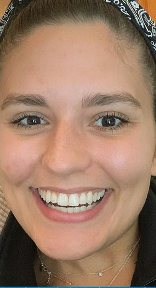 INVISALIGN CLEAR ALIGNERS After